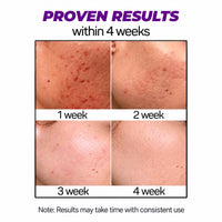Anti-Acne Serum – For Acne, Pimples, Dark Spots & Oil Control