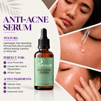 Anti-Acne Serum – For Acne, Pimples, Dark Spots & Oil Control